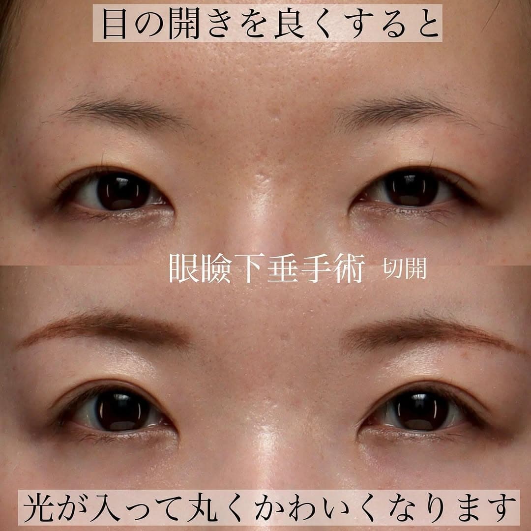 眼瞼下垂手術で黒目全体が見えるようになり目の開きと印象を改善した症例