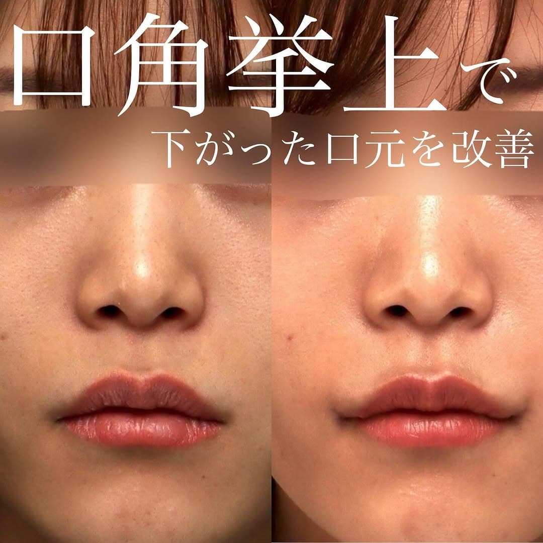 口角挙上で真顔でも斜めから見ても口角が下がっていない自然な口元に整えた症例