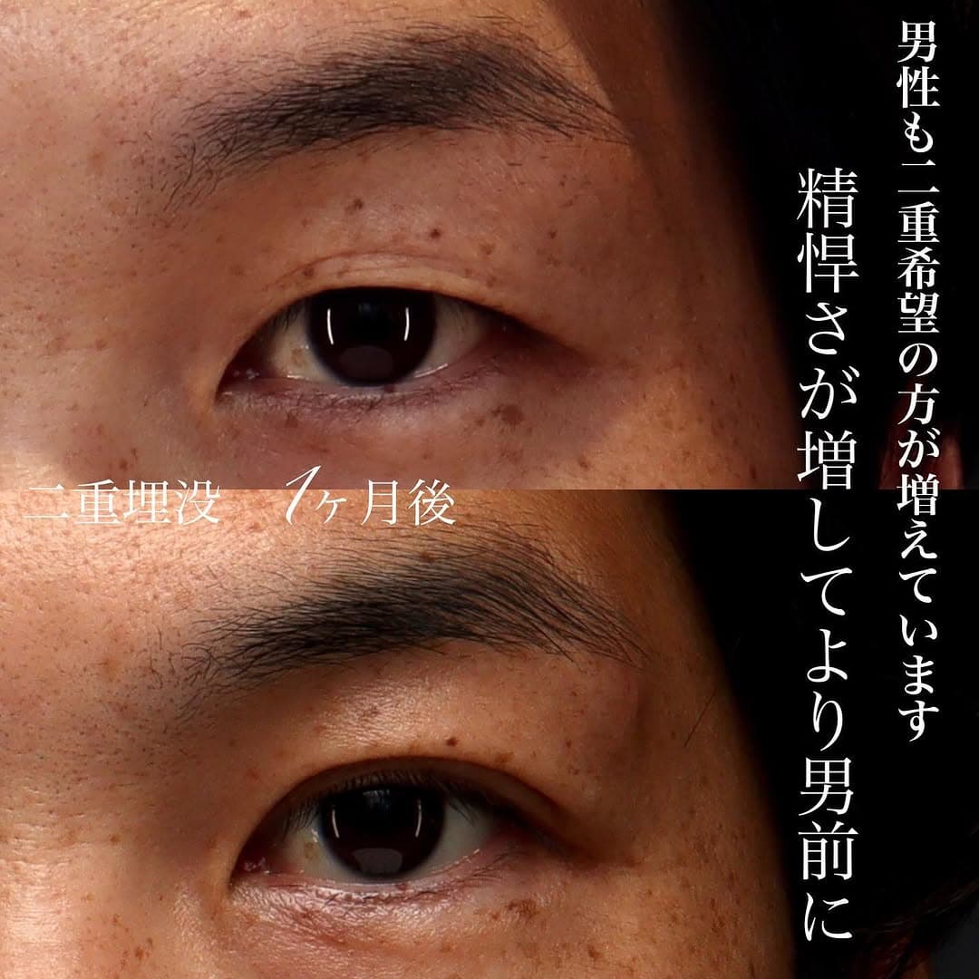 男性の二重埋没で左右差を改善し精悍な目元に(術後1ヶ月)