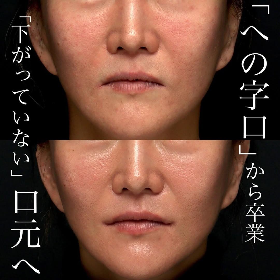口角挙上で「口角が下がっていない」自然な口元の印象を整えた症例