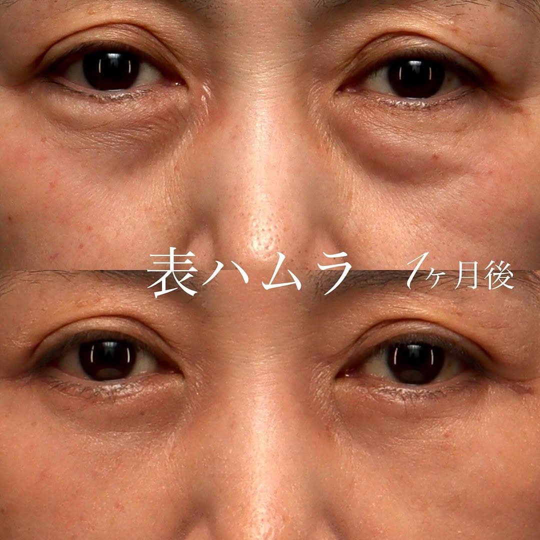 表ハムラでたるみ・膨らみ・へこみをまとめて改善した目の下クマの症例