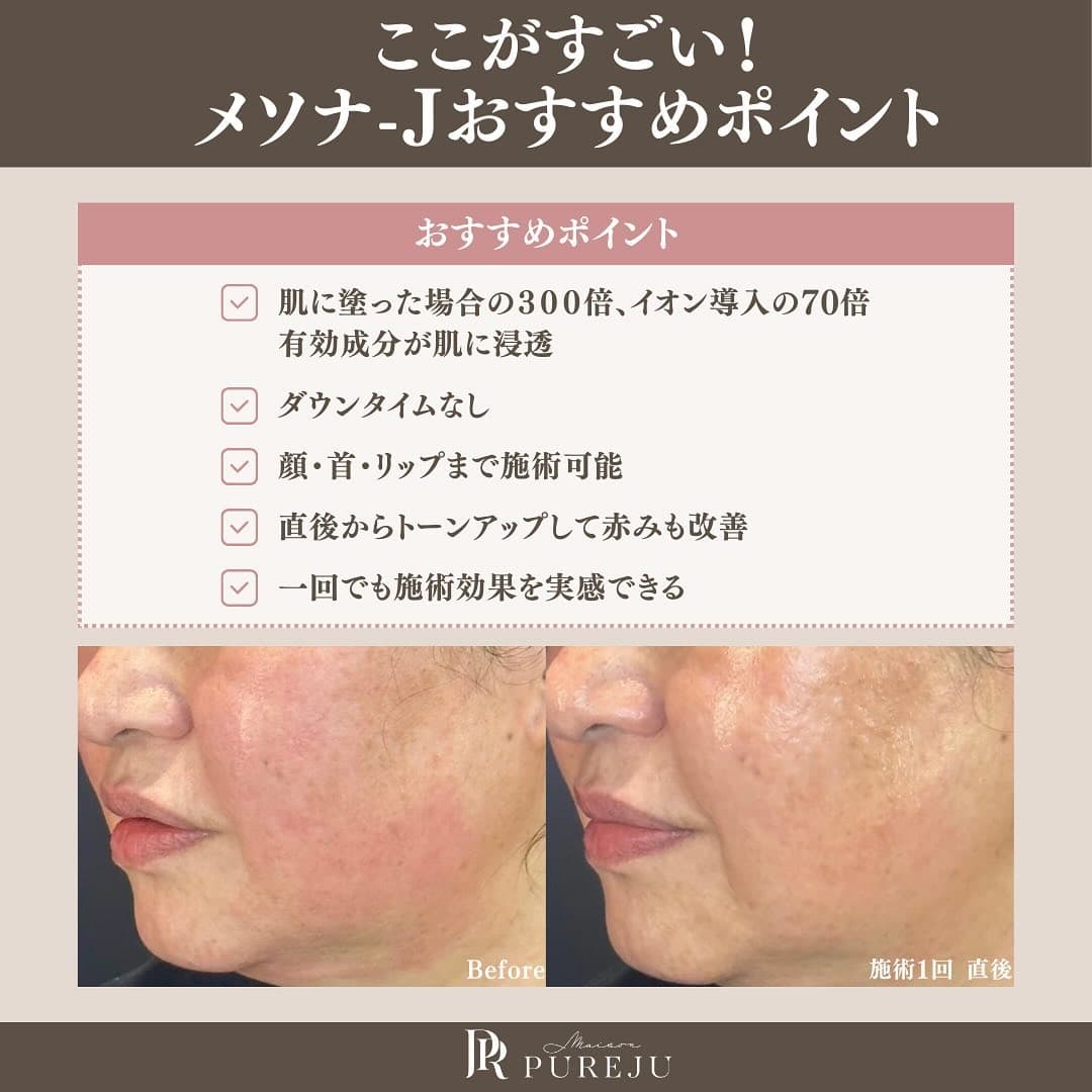 メソナJのピンク・プレミアム2コース比較|導入薬剤と当院5つのこだわりを徹底解説