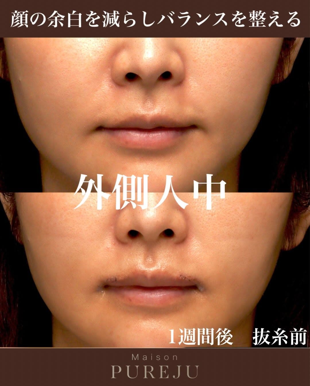 外側人中手術で唇のバランスを立体的に改善し口元の印象を整えた症例