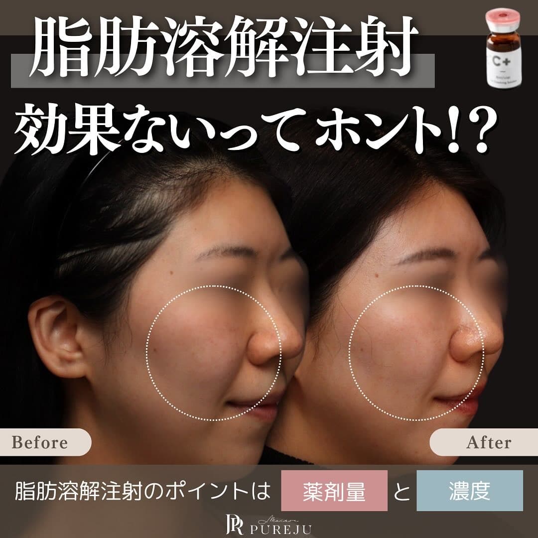 脂肪溶解注射は効果ない?|チンセラプラスのデオキシコール酸濃度と注入量が結果を左右する理由