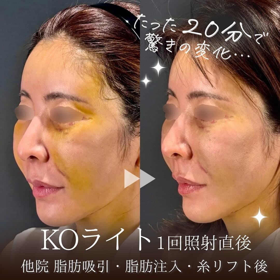KOライトで術後の腫れと黄色い内出血を素早く改善したダウンタイム対策症例