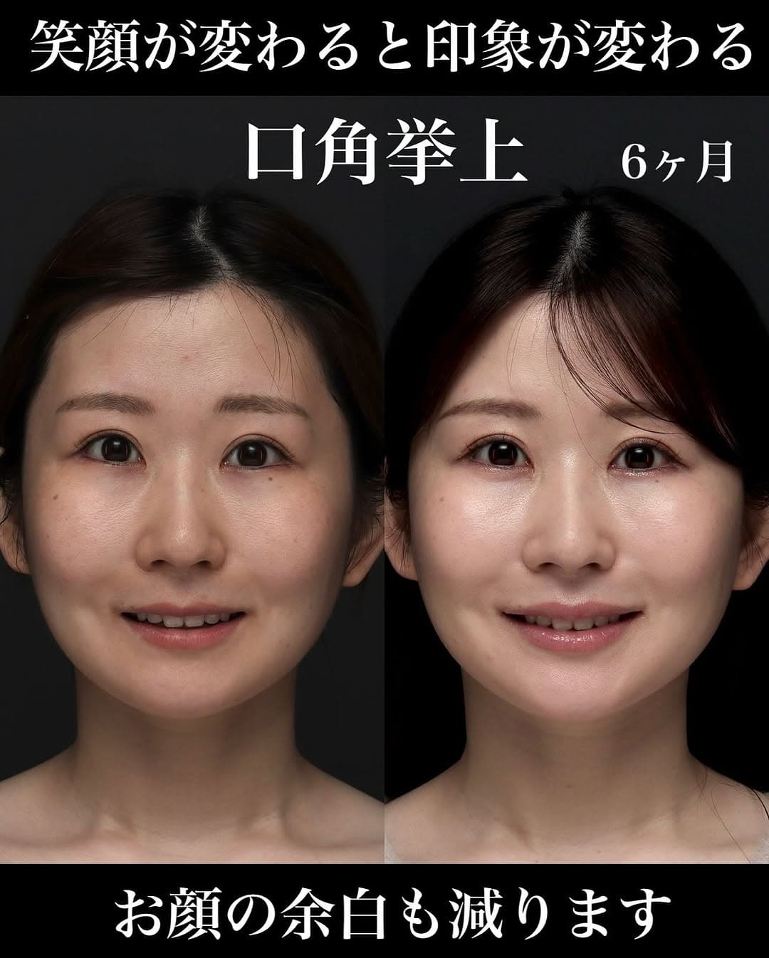 口角挙上+ヒアルロン酸で術後6ヶ月笑顔が格段に良くなった症例