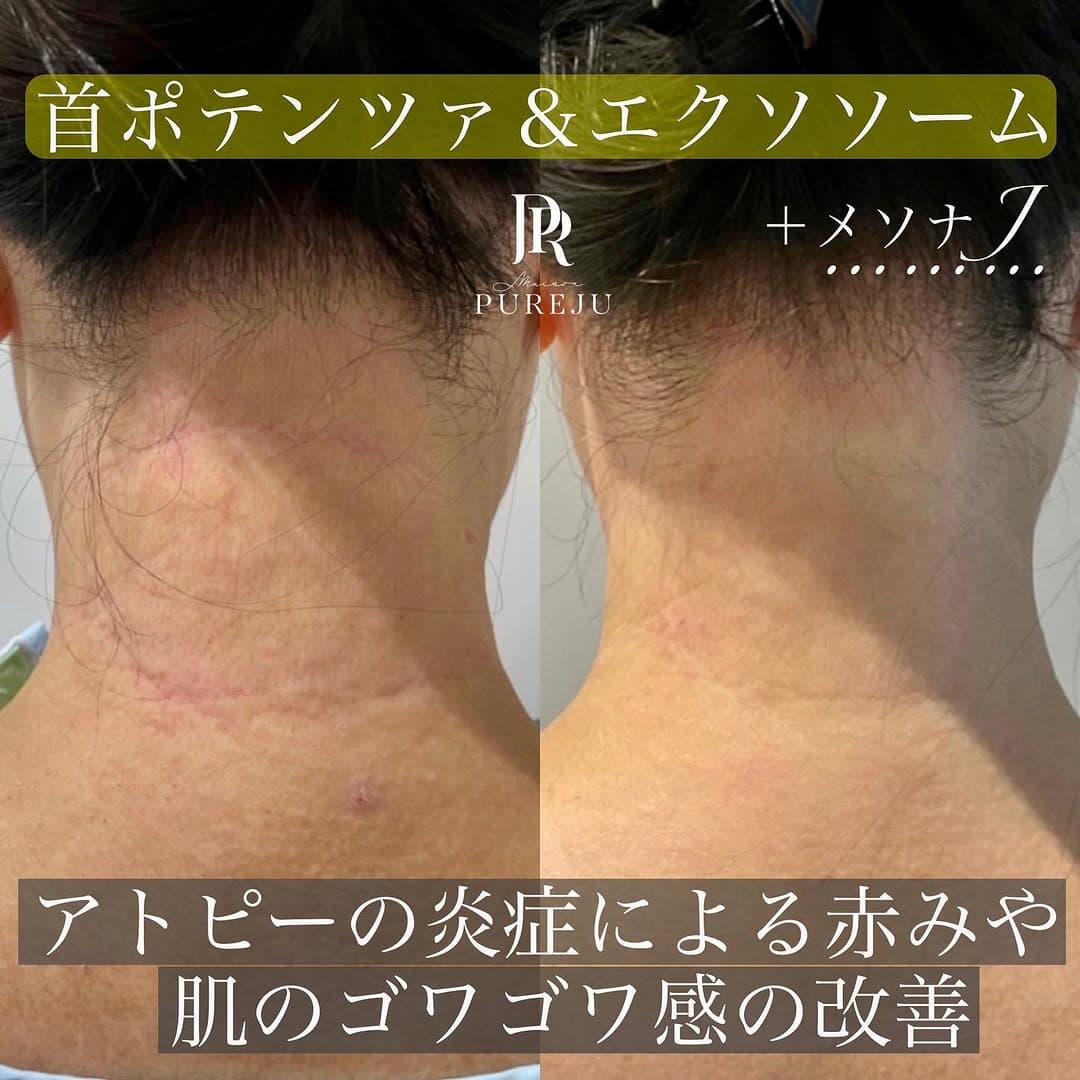 首のアトピー性皮膚炎にポテンツァ×エクソソーム×メソナJで肌の炎症と赤みを改善した症例