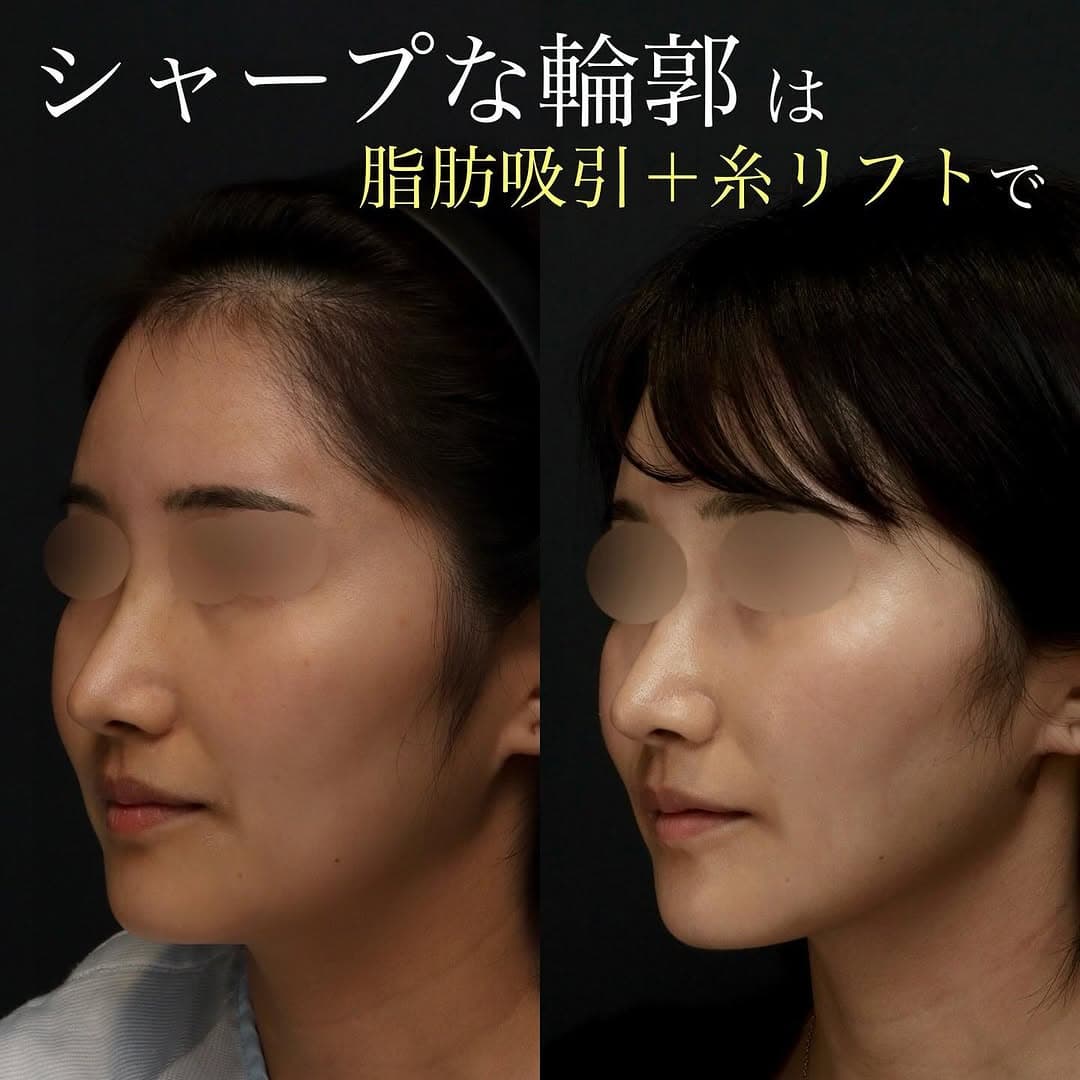 糸リフト+脂肪吸引の組み合わせでしっかり小顔に整えた症例