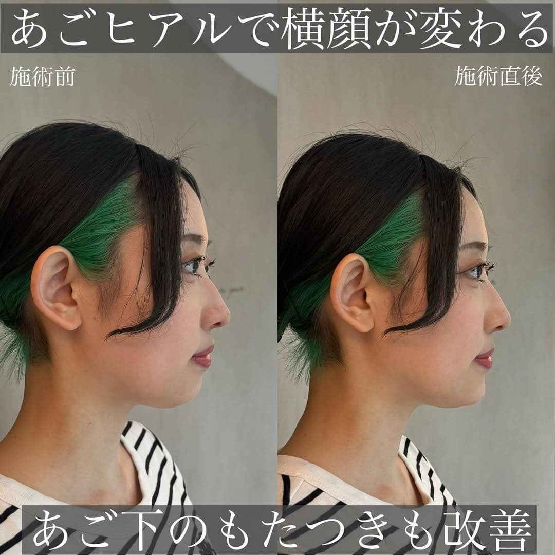 あごのヒアルロン酸で輪郭のバランスを自然に整えた症例
