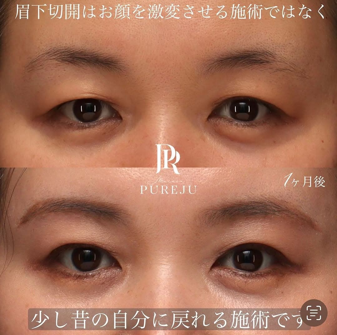 眉下切開でまぶたのたるみを改善し少し昔の自分に戻った症例(術後1ヶ月)