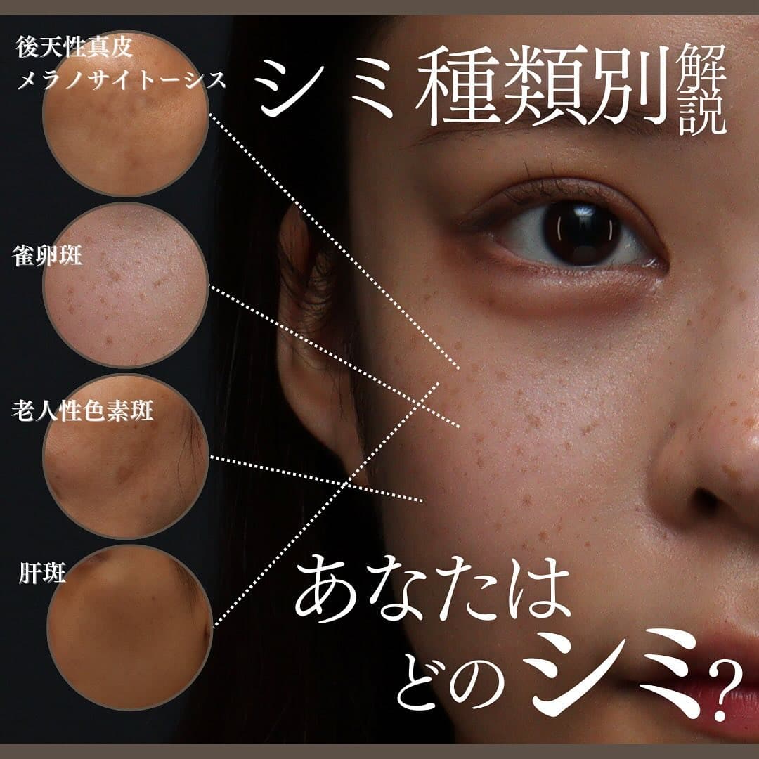 シミの種類4つを徹底解説|ADM・そばかす・老人性色素斑・肝斑の特徴とおすすめ治療