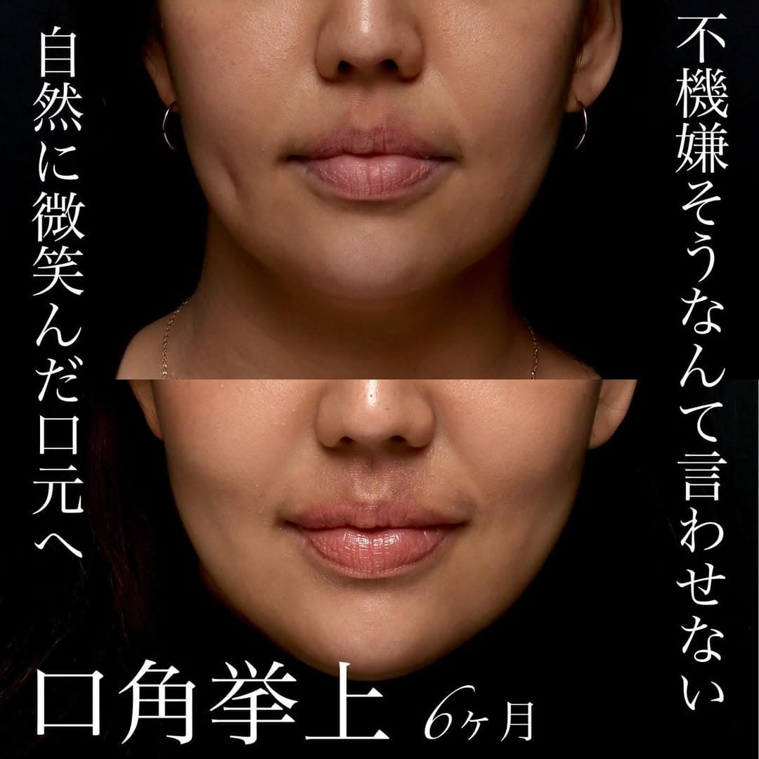 口角挙上でふとした瞬間も口角が下がらない印象の良い口元になった症例