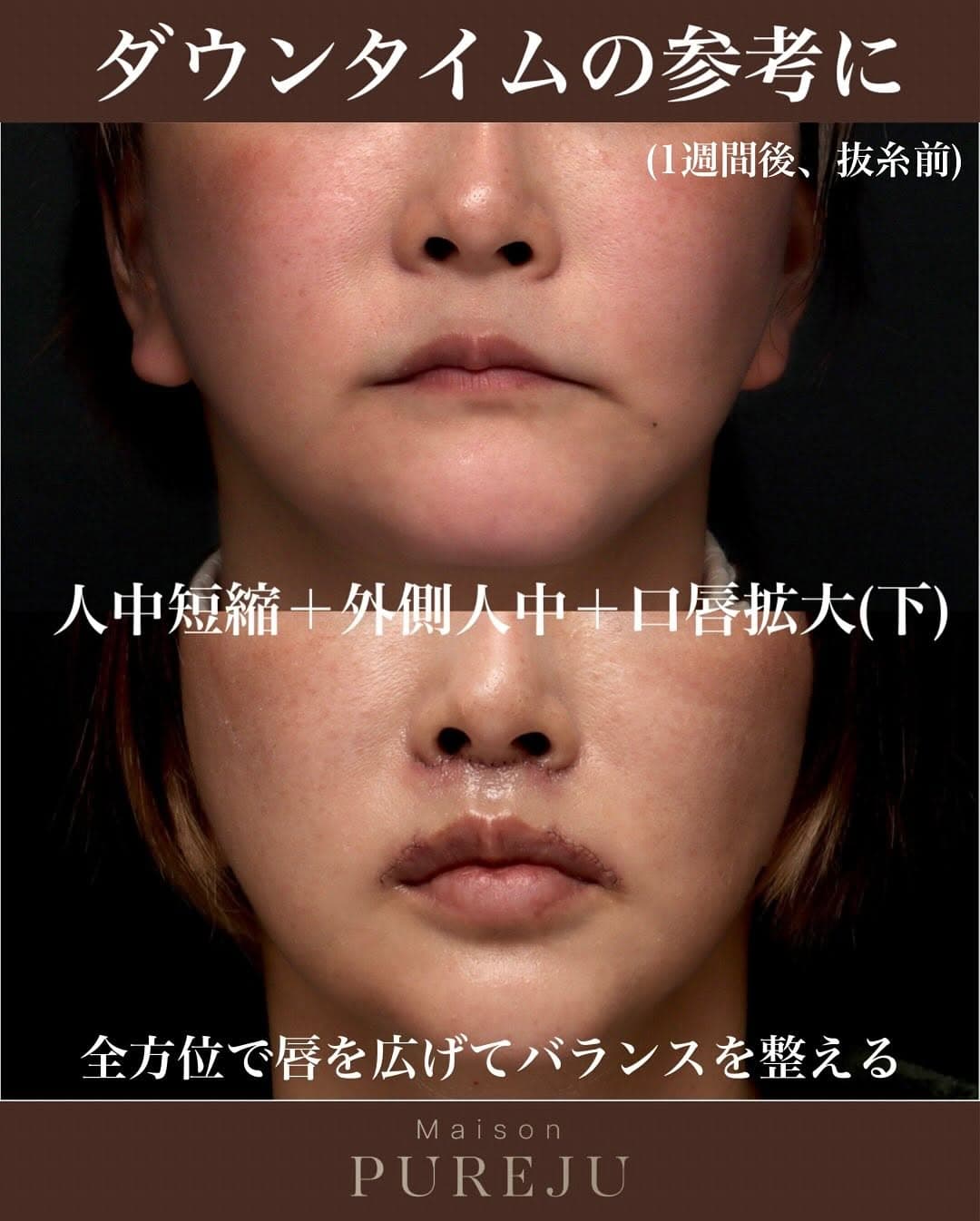 人中短縮+外側人中+口唇拡大で唇を全方位から拡大した術後1週間の症例
