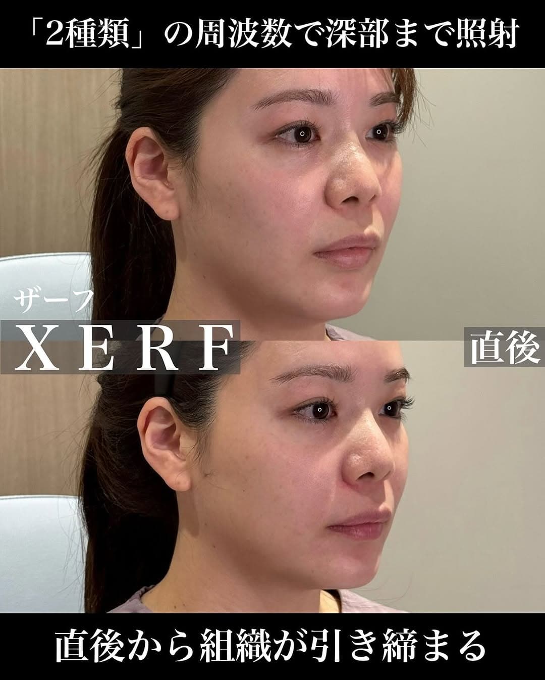 ザーフ(XERF)直後のフェイスラインのピタッとした引き締め効果を実感した症例