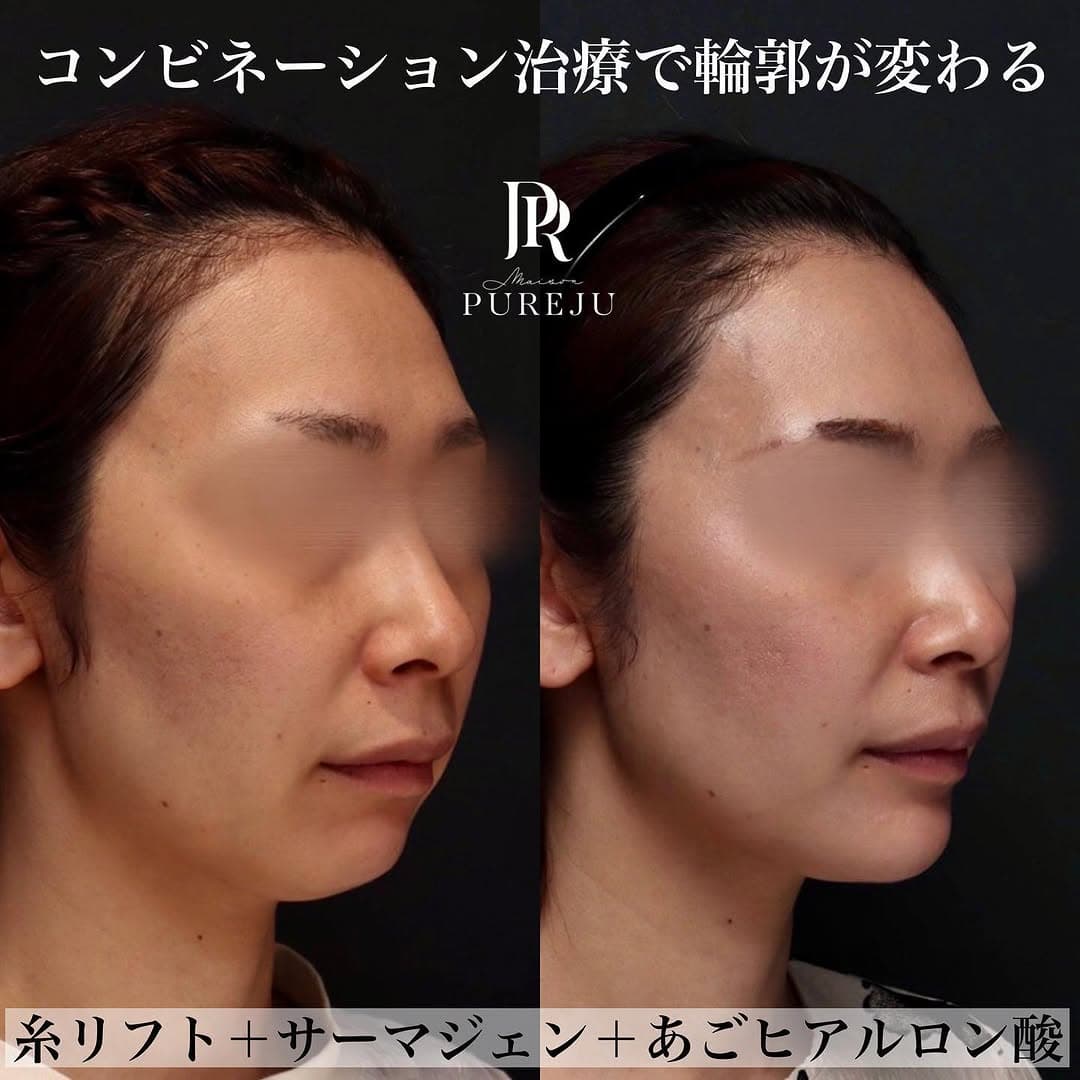 糸リフト×サーマジェン×ヒアルロン酸のコンビネーション治療でフェイスラインを整える