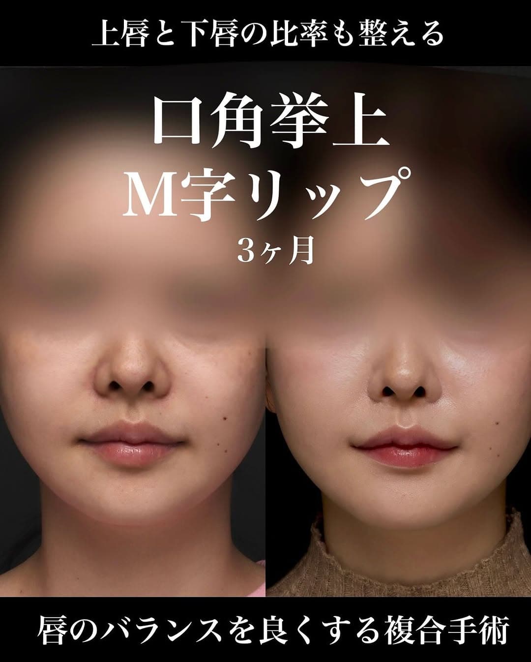 口角挙上+M字リップで唇の黄金比に近づけ上品な印象に整えた症例