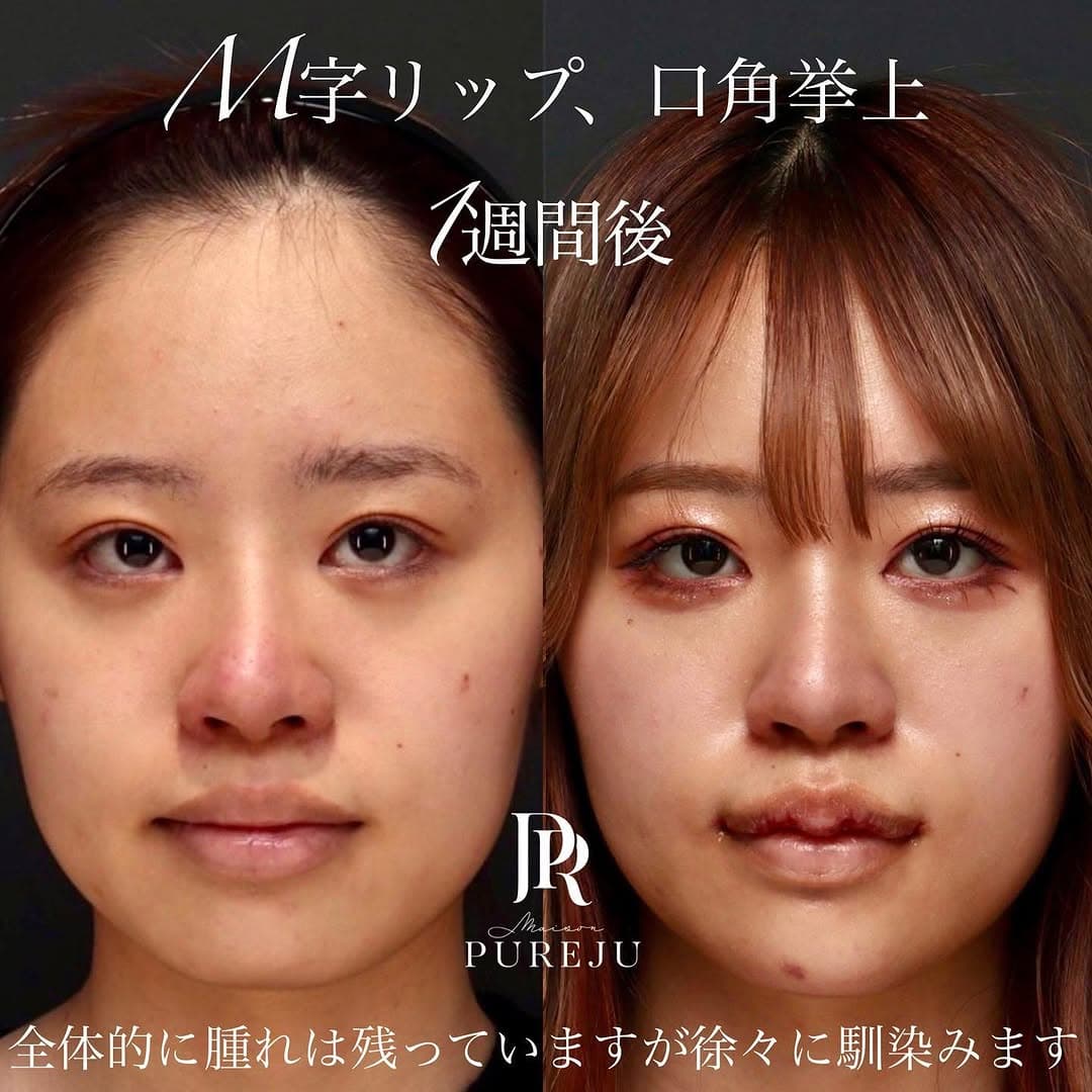 M字リップと口角挙上の組み合わせで口元の印象を整える(術後1週間)