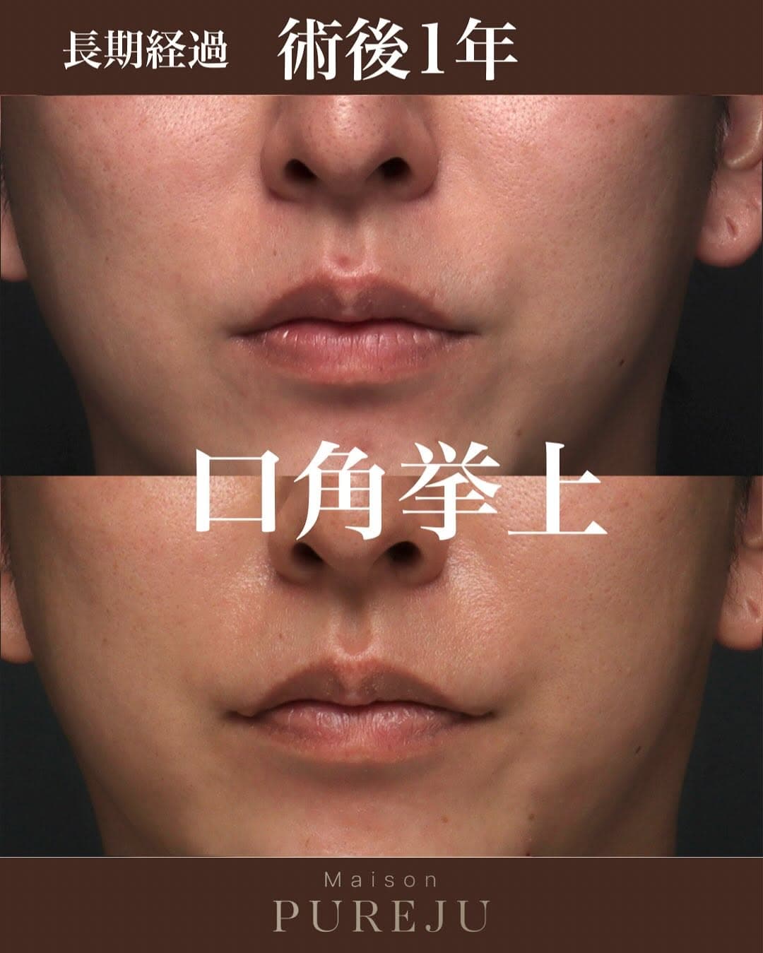口角挙上術後1年の長期経過で笑いやすさ・しゃべりやすさも維持している症例