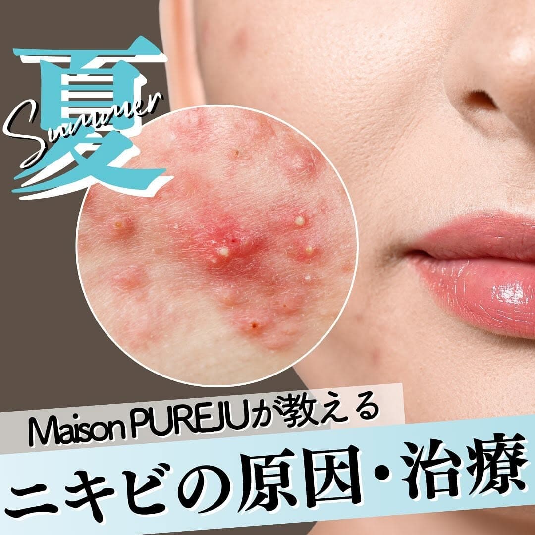 夏のニキビの原因と治療法|紫外線・エアコン乾燥・皮脂過剰・ターンオーバー乱れへの4つのアプローチ