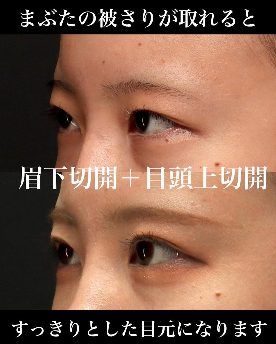 眉下切開+目頭上切開でまぶたのたるみを全体的に改善し斜め方向も綺麗になった症例