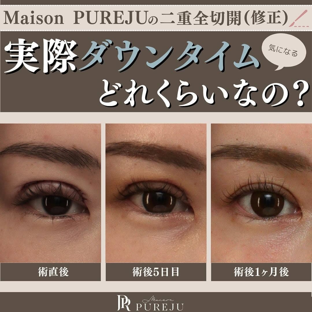 二重全切開(修正)のダウンタイムはどのくらい?術直後〜1ヶ月の経過と過ごし方を解説