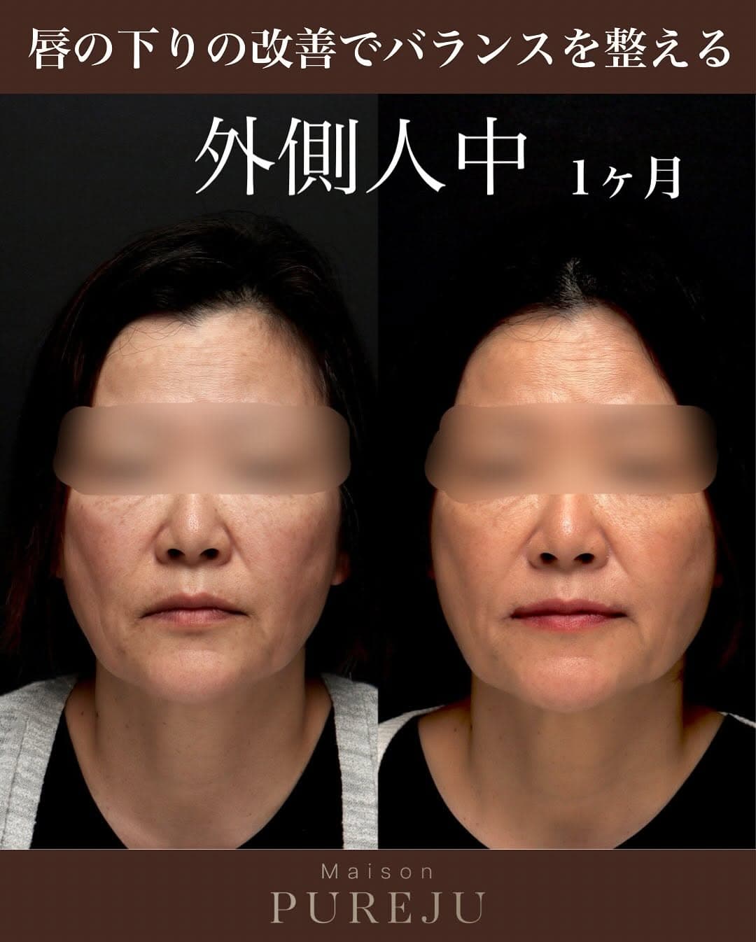 外側人中短縮で唇の外側を持ち上げお顔の余白を改善した術後1ヶ月の症例