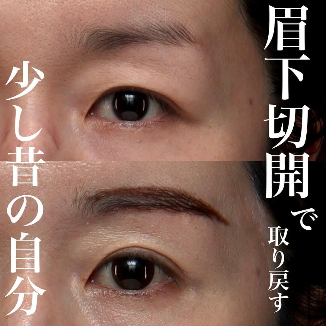 眉下切開で少し昔の自分に戻るアンチエイジング効果を実感した症例