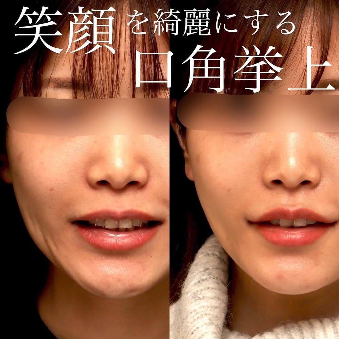 口角挙上で笑いやすく笑顔が綺麗になった症例