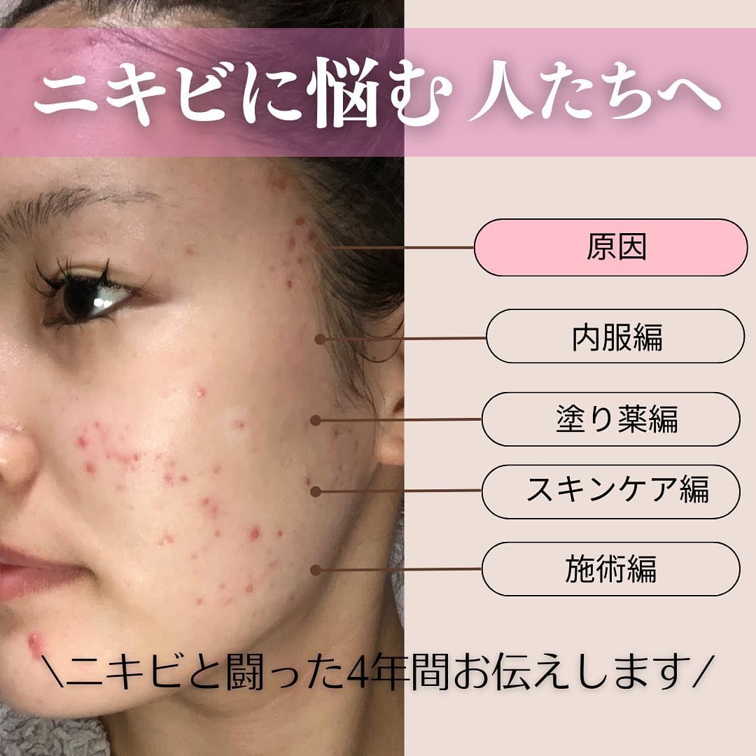 ニキビに悩む人たちへ - 私が4年間闘った経験をお伝えします