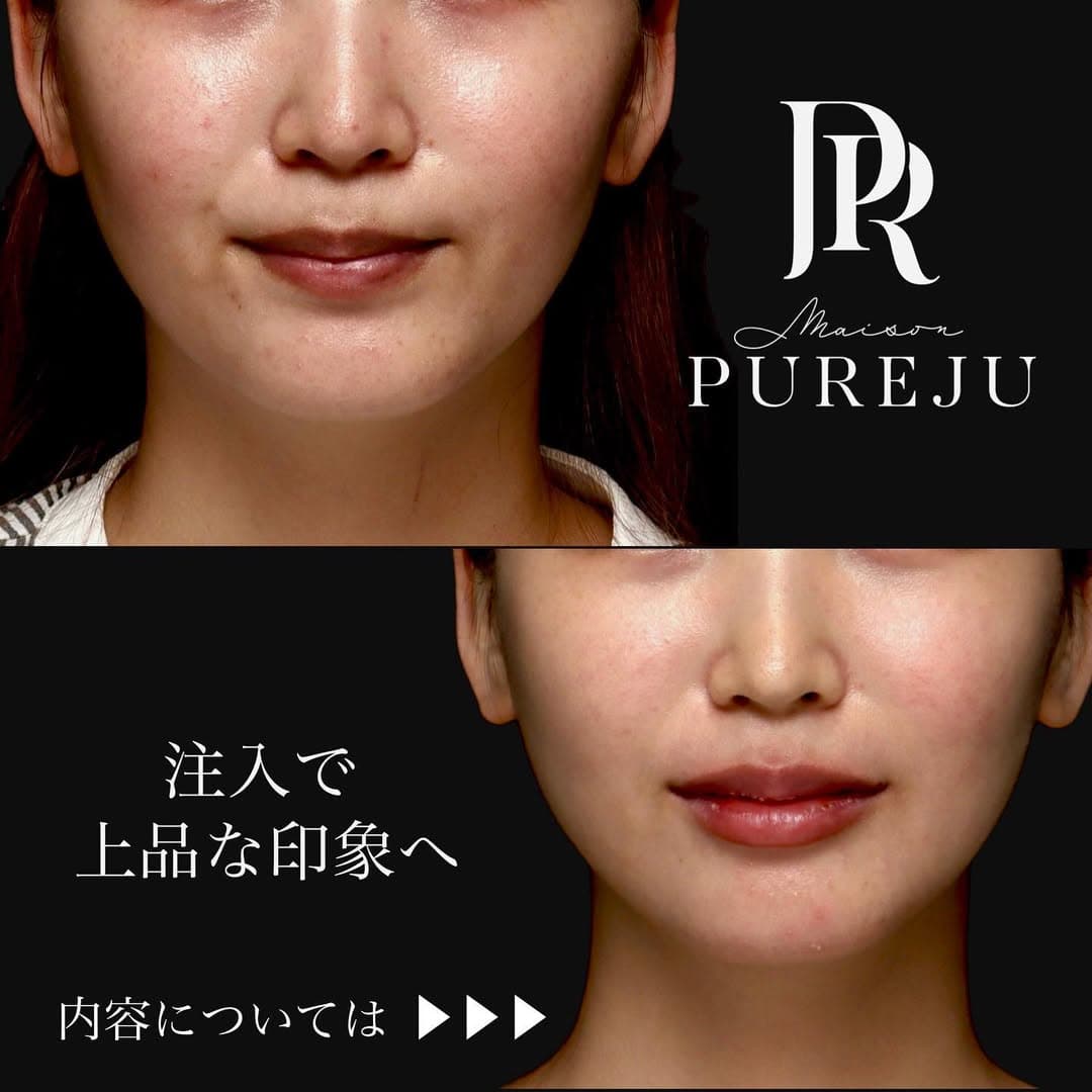 ボトックス×ヒアルロン酸(頬・唇)のトータル注入で上品な印象に整えた症例