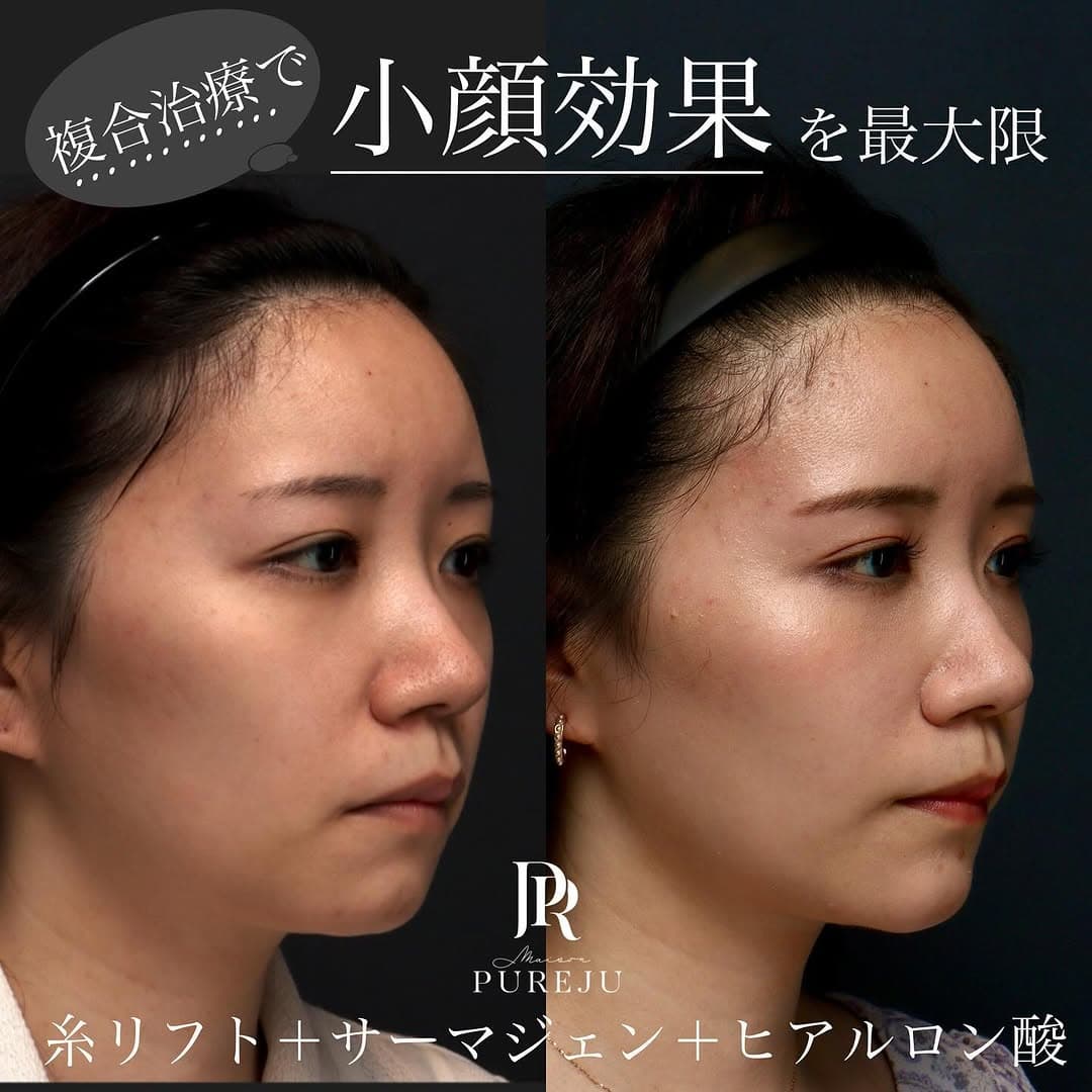 糸リフト+サーマジェン+ヒアルロン酸+ボトックスのコンビネーションでバランス良く小顔に整えた症例