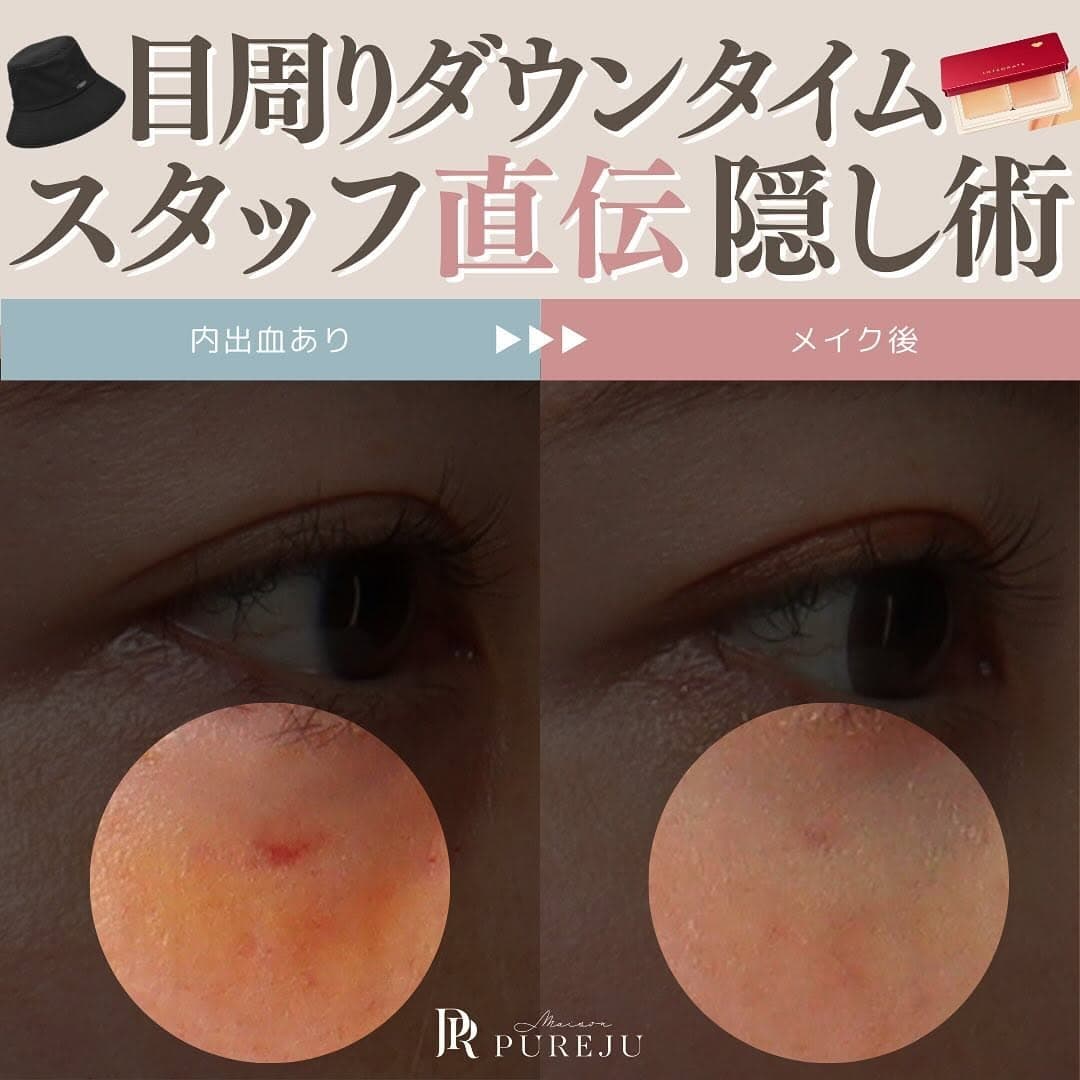 目周りのダウンタイムを隠す方法|服装アイテムと内出血を消すコンシーラーの使い方