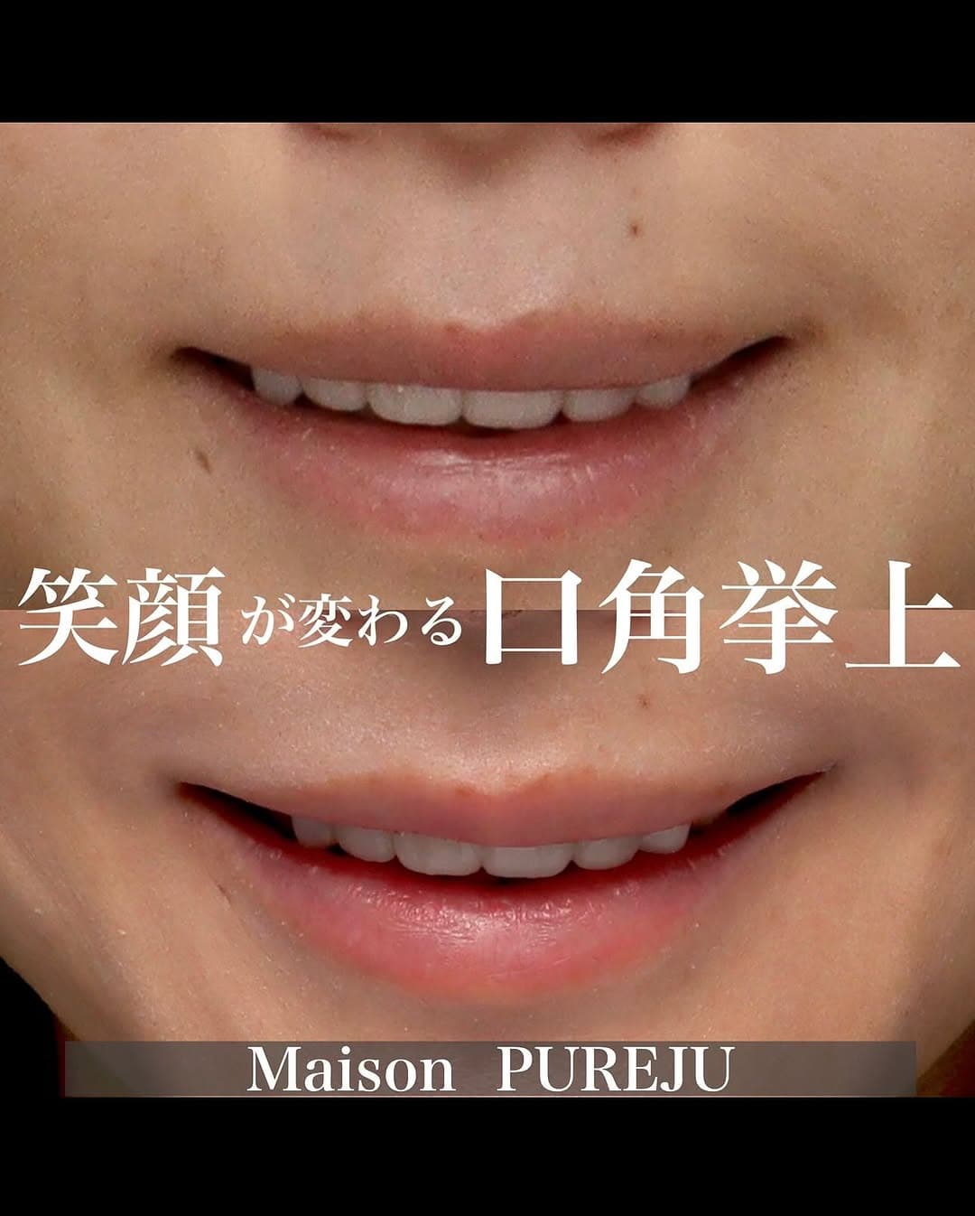 口角挙上で笑顔が変わり笑いやすさとお顔の余白改善を実現した症例