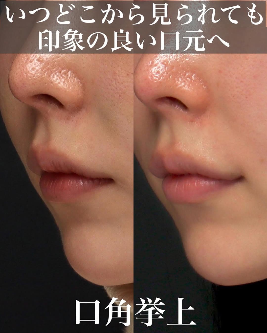 口角挙上でふとした瞬間も口角が下がらずかわいい印象をキープした症例
