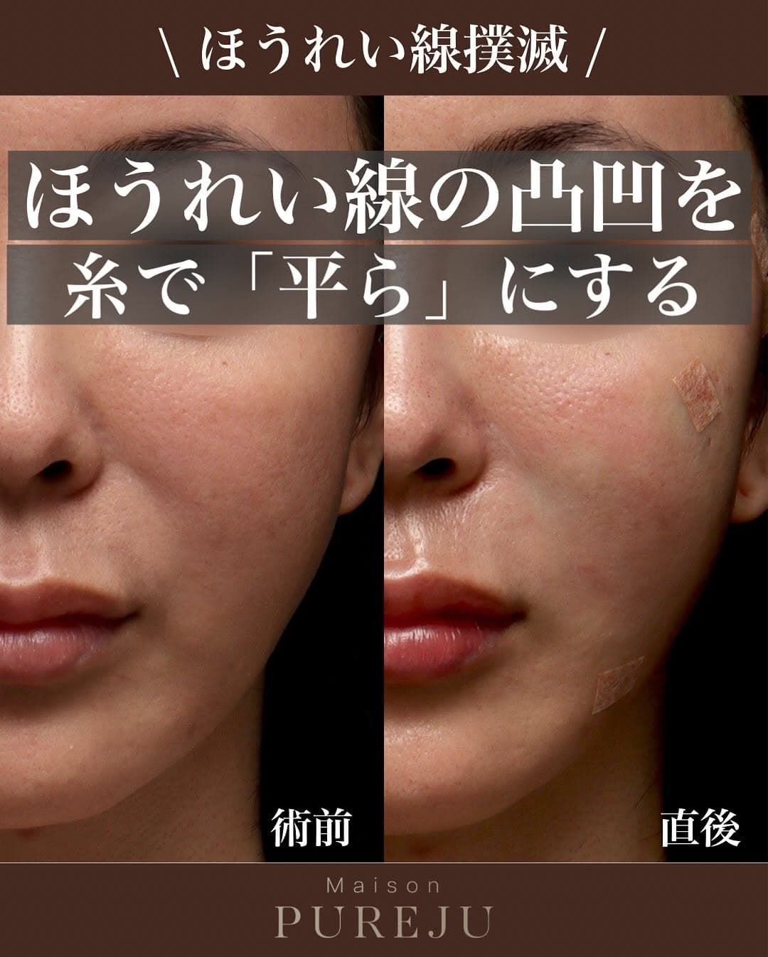 マルチフィル+フラットリフト+糸リフトでほうれい線の段差を平らにした症例
