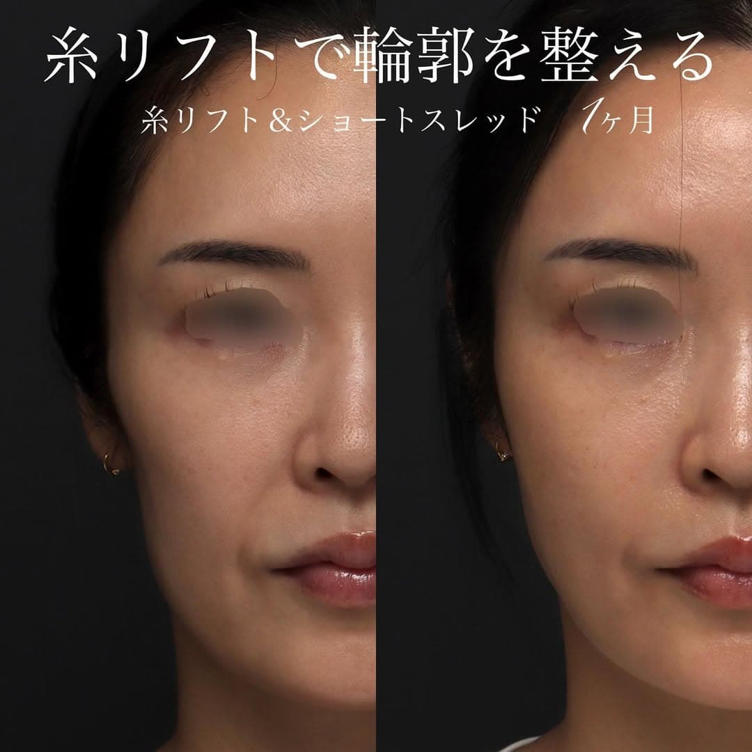 糸リフトの適材適所な使い分けでフェイスラインを自然に整えた症例