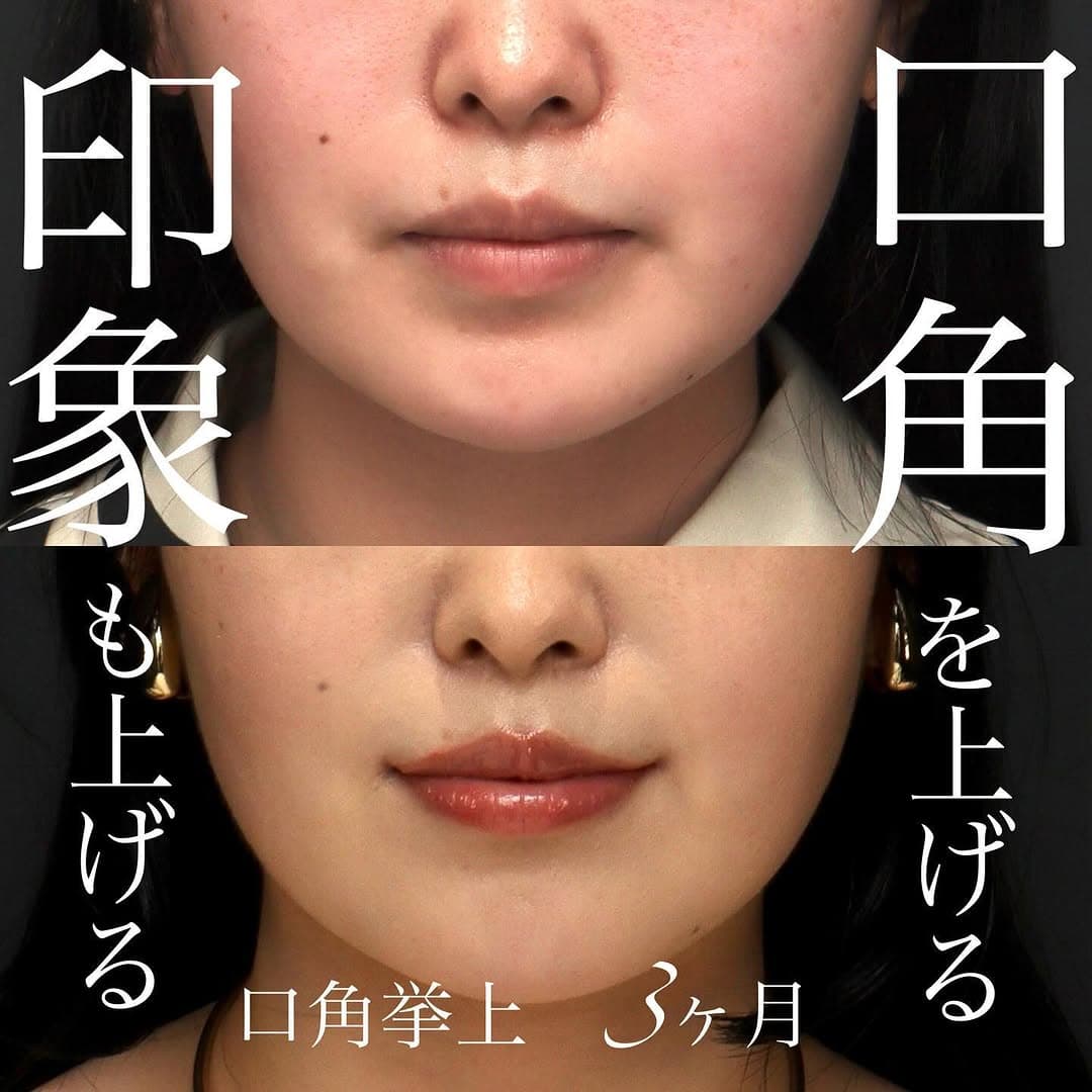 口角挙上で真顔でも口角が上がり印象が良くなった症例