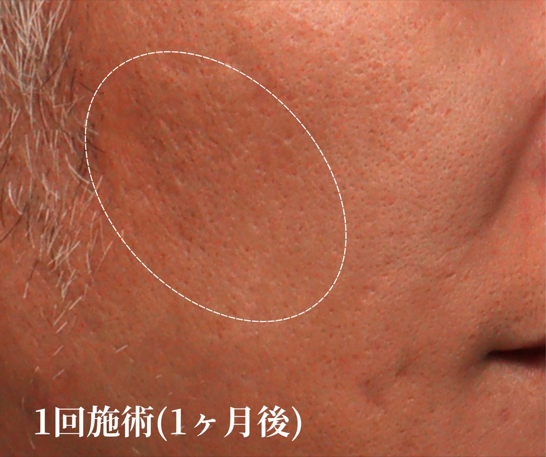 治療1ヶ月後