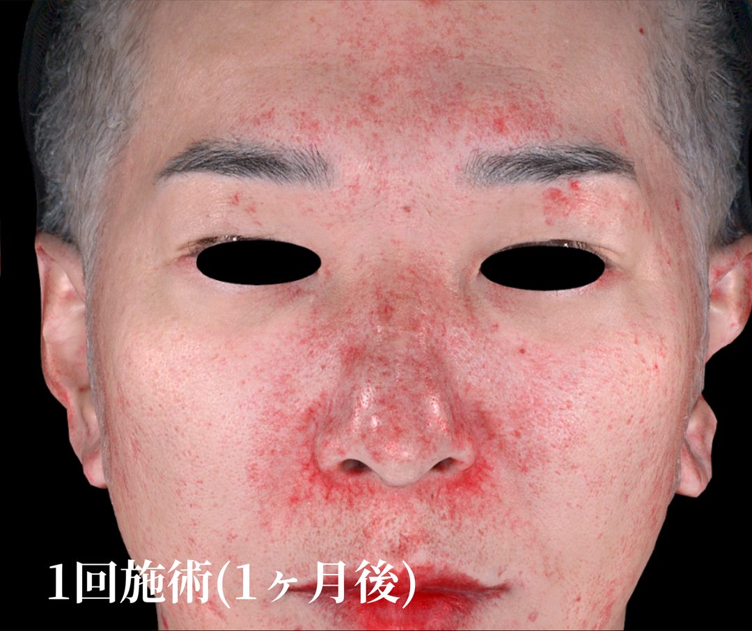 治療1ヶ月後
