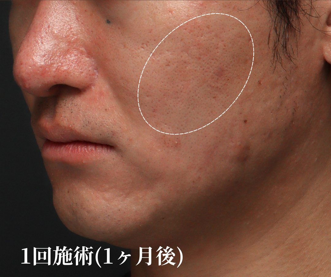 治療1ヶ月後
