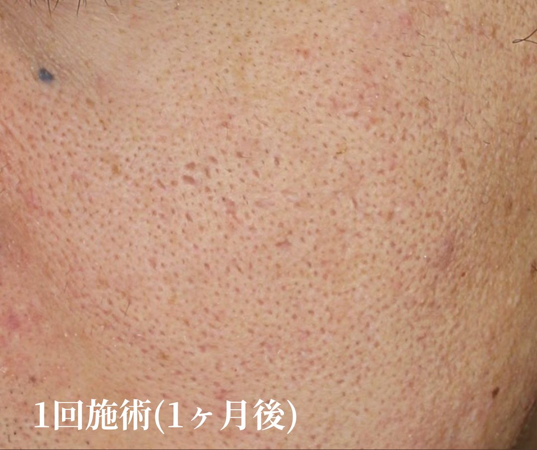 治療1ヶ月後