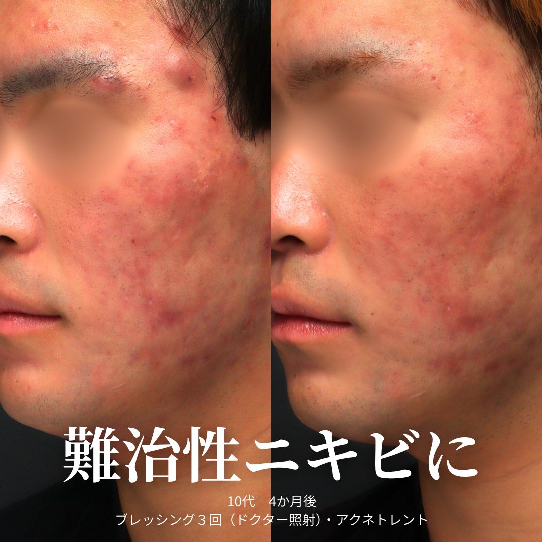 頬：治療前（左）と治療4ヶ月後（右）