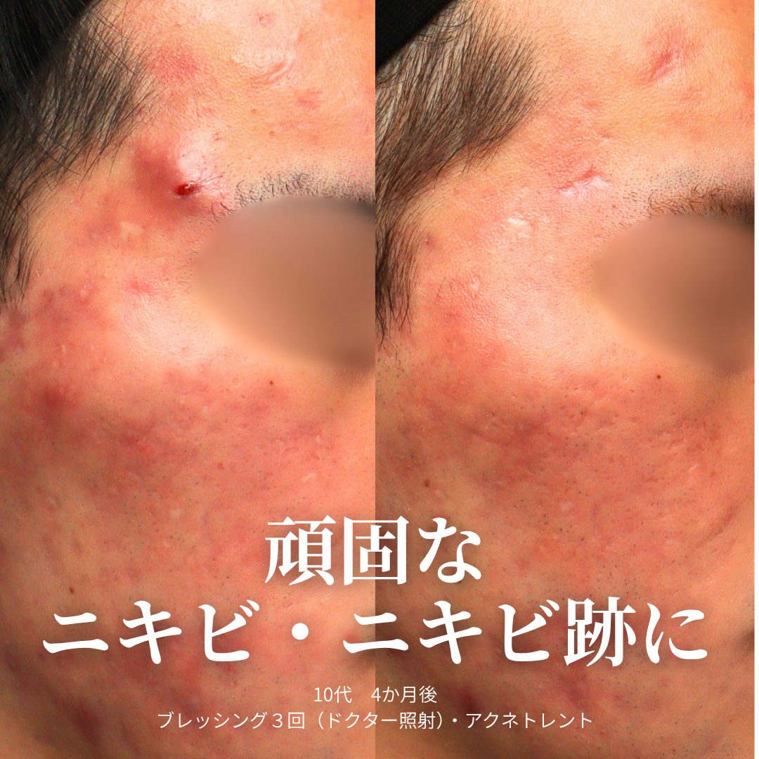 頬の寄り：治療前（左）と治療4ヶ月後（右）