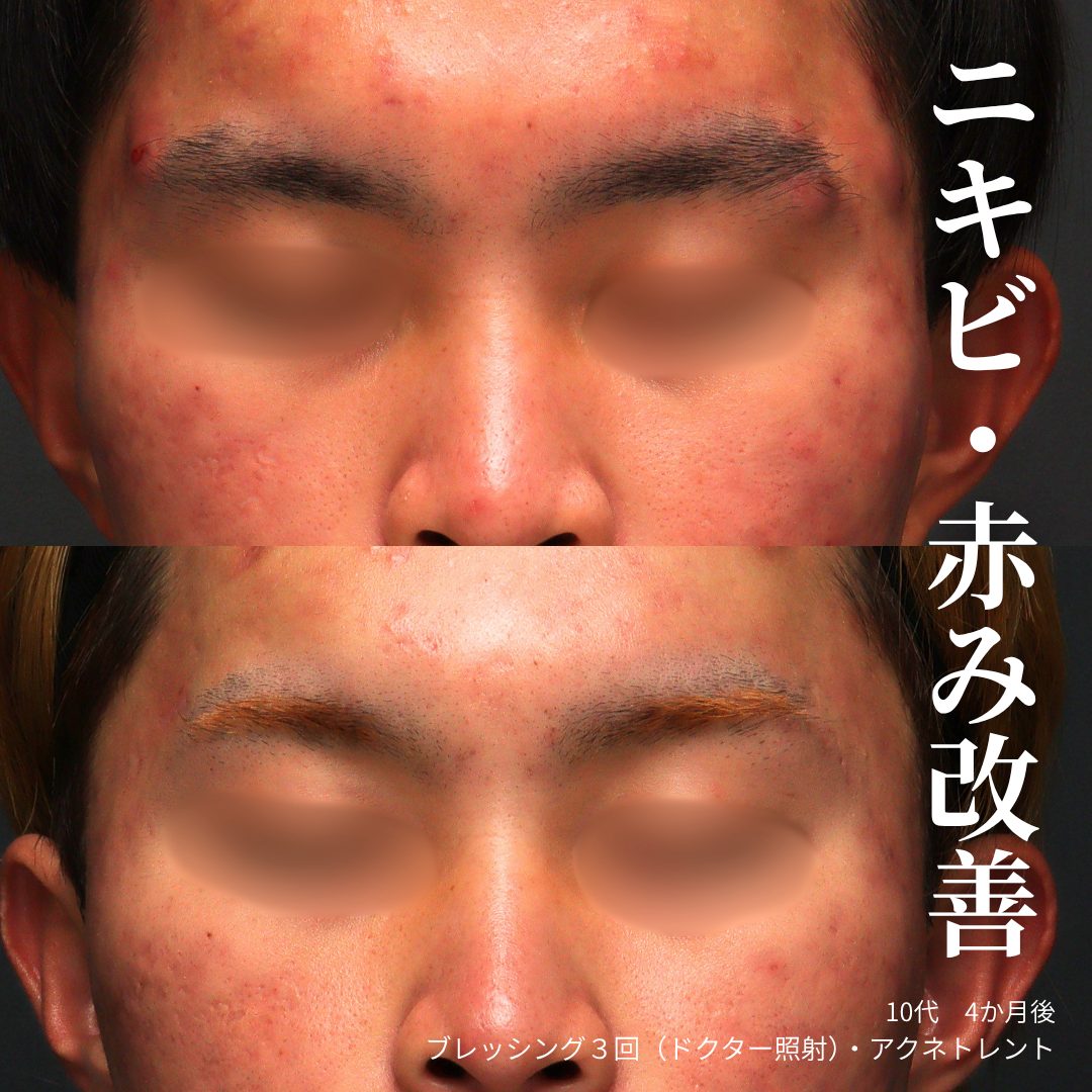 ブレッシング、アクネトレントの症例（治療前後の写真）