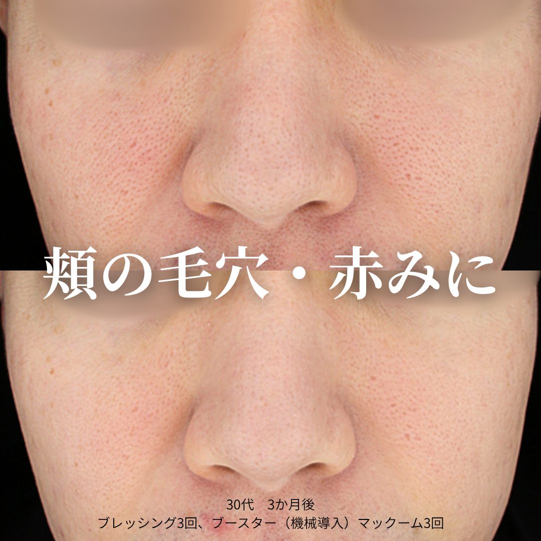 治療前（左）と治療3ヶ月後（右）