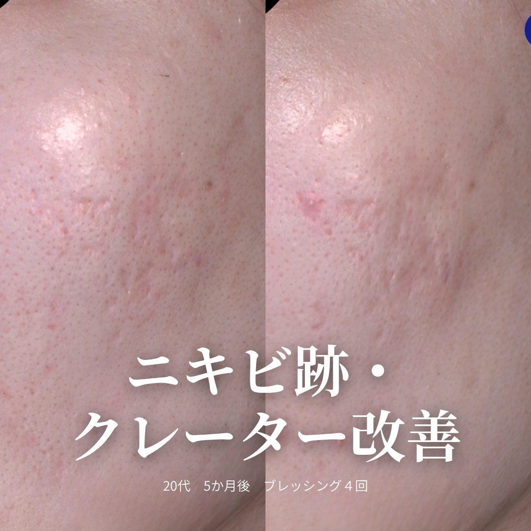 治療前（左）と4回後・5ヶ月後（右）