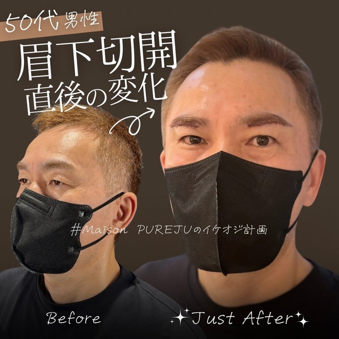 眉下切開の症例(治療前後の写真)