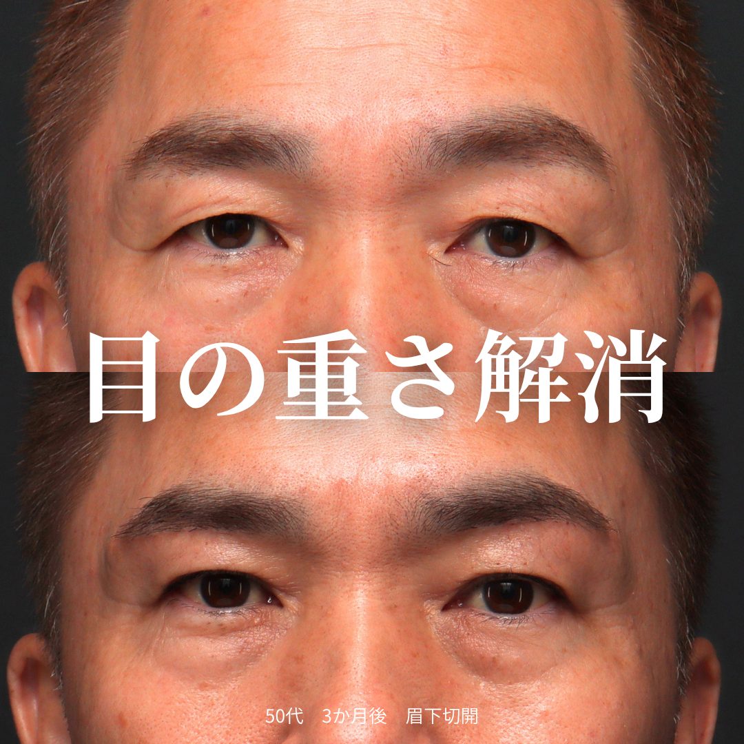眉下切開の症例（治療前後の写真）