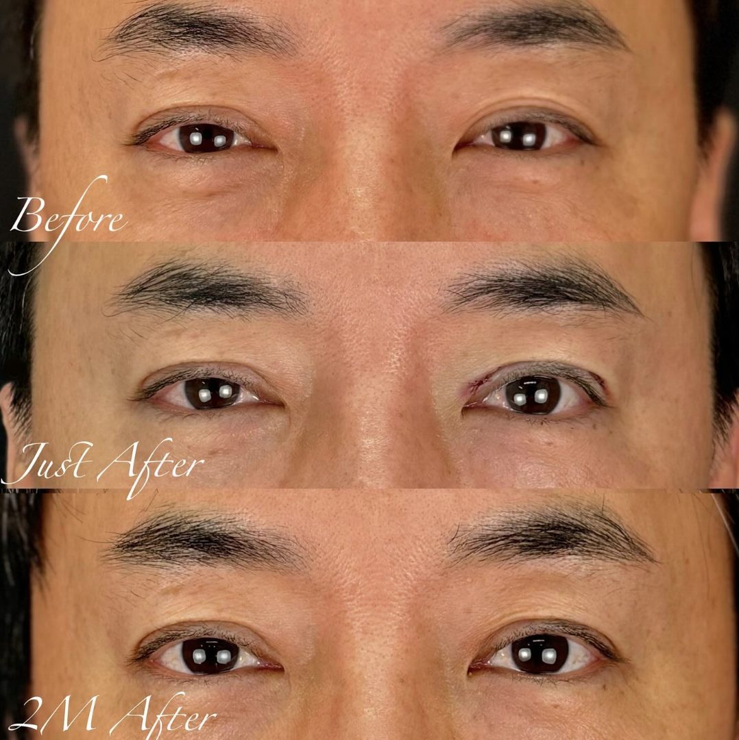 二重の左右差の調整の症例(治療前後の写真)