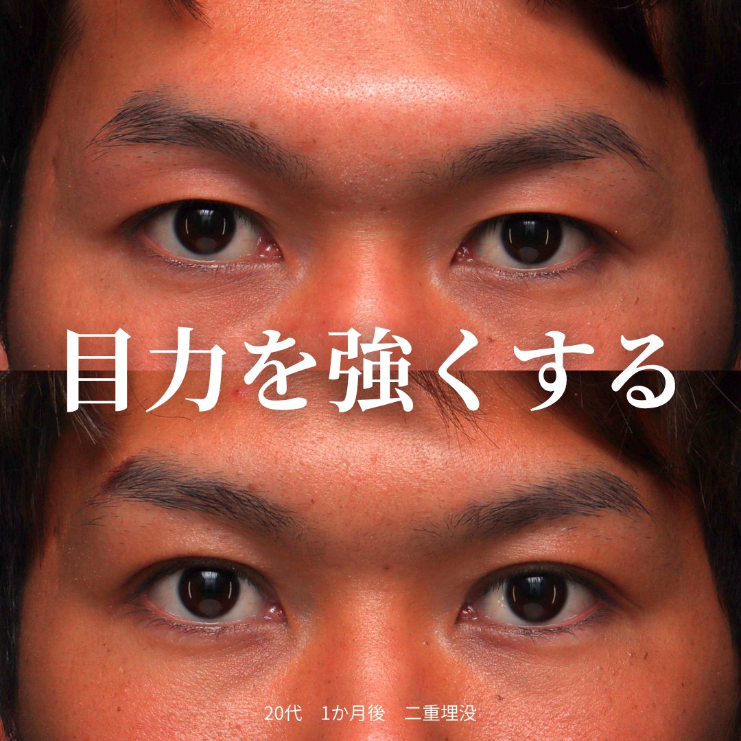 二重埋没の症例（治療前後の写真）